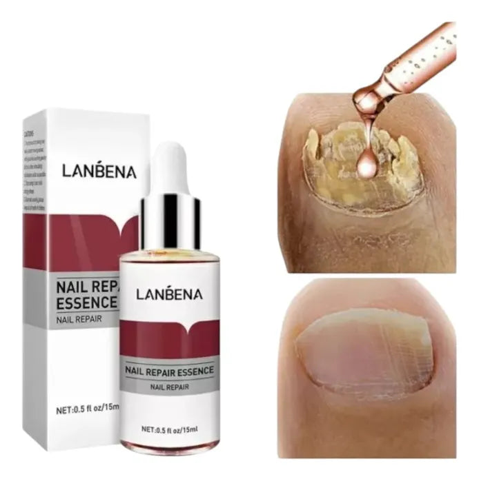 LANBENA TRATAMIENTO PREMIUM ANTIHONGOS